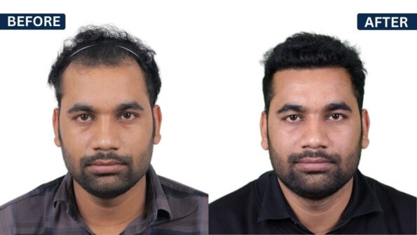 hair transplant in Bangalore