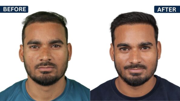 before after hair transplant result in Bangalore