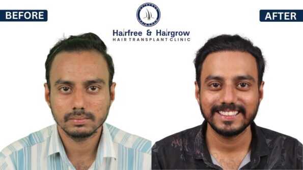 hair transplant in Bangalore result