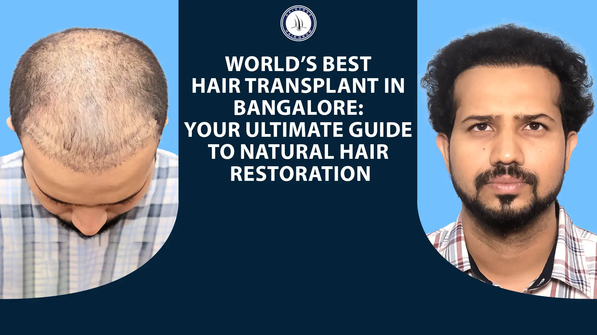 Best Hair Transplants in Bangalore for Hair Restoration