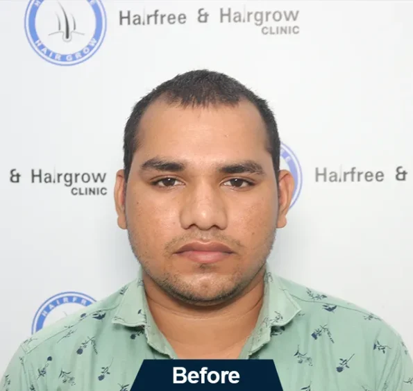Front-view collage – patient before, Day 1, and Month 7 result of FUE hair transplant in Ludhiana