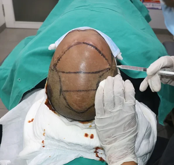 Surgeon administering local anesthesia using vibration-assisted method