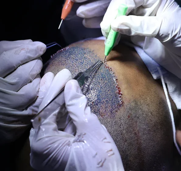 Immediate post-op frontal view with implanted grafts and dressing