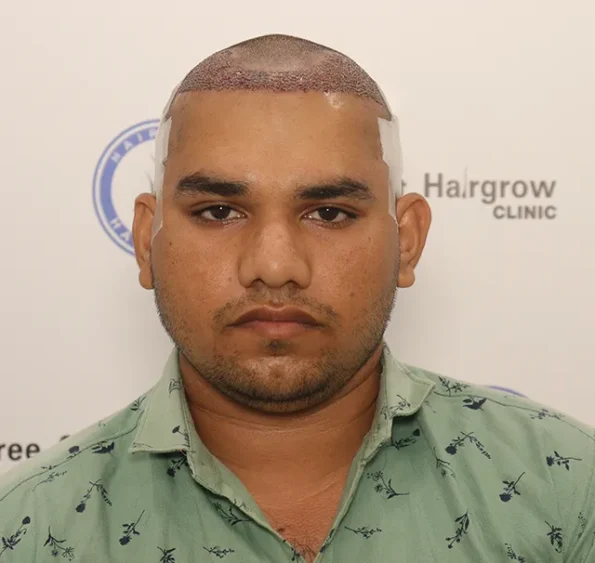 Month‑1 top view showing expected shedding phase after transplant