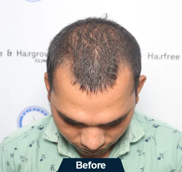 Top-view collage showing scalp before surgery, immediate post-op, and seven-month progress in Ludhiana