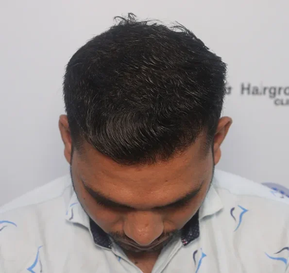 Month‑11 final frontal view – full hairline restoration and styling freedom