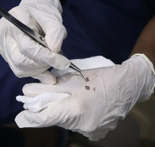 Implanter pen placing grafts into prepared slits on patient scalp