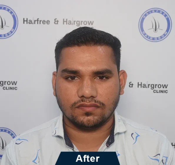 Right-profile sequence showing receding hairline to dense regrowth after 7 months in Ludhiana