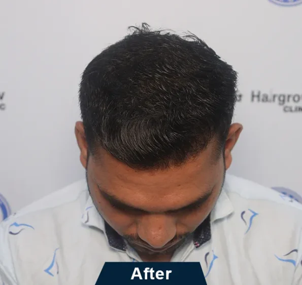 Left-profile sequence highlighting natural density restored after transplant in Ludhiana