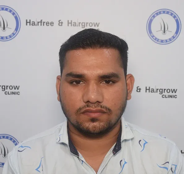 Month‑11 top view showing complete crown coverage restored in Ludhiana