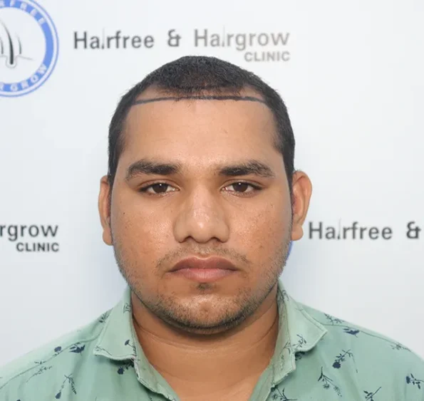 Patient frontal view before transplant showing advanced recession and crown thinning