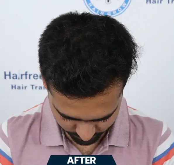 Top-view collage showing scalp before surgery, immediate post-op, and seven-month follow-up