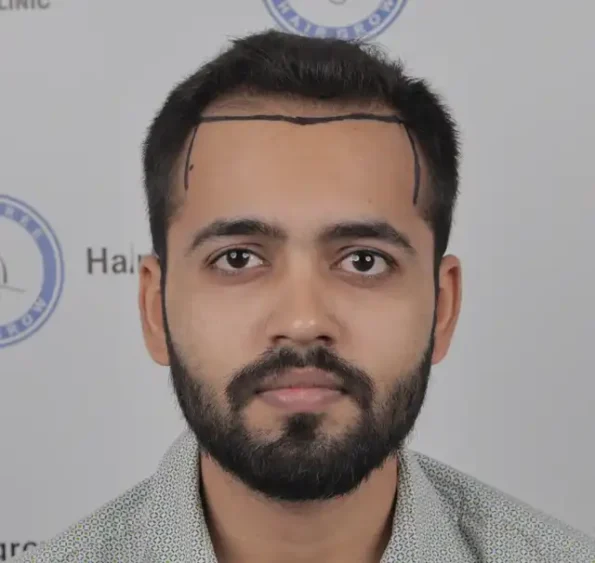 Patient frontal view before surgery showing advanced recession and crown thinning