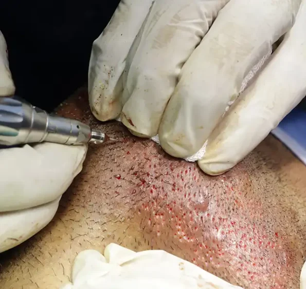 Extracting follicular grafts with 0.8 mm punch during FUE hair transplant