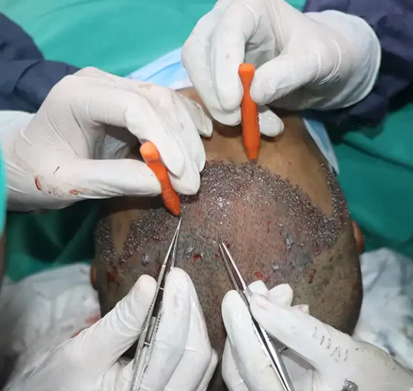 Implanter pen placing grafts into prepared slits on patient scalp