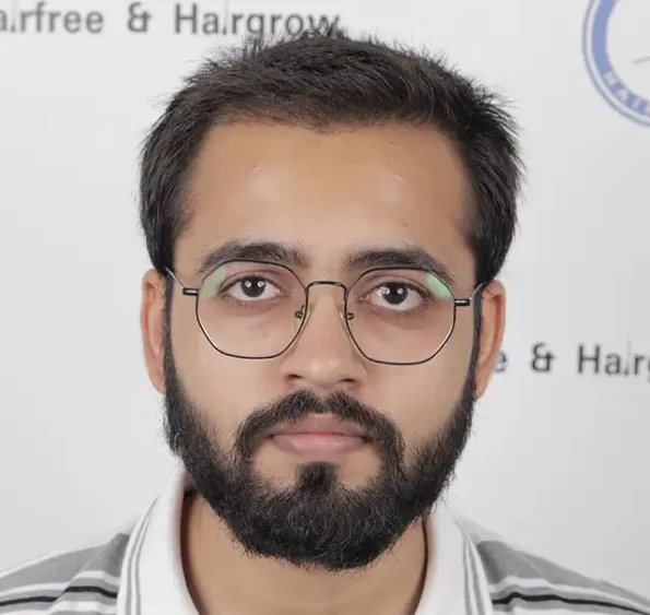 Month 3 front view – early baby hairs emerging after hair transplant