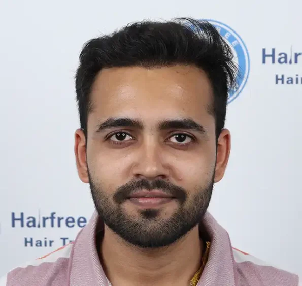 Month 11 final result – full hairline restoration and styling freedom