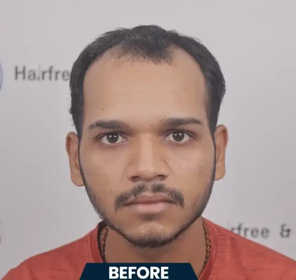 Front-view collage – patient before, Day 1, and Month 7 result of FUE hair transplant in Chandigarh