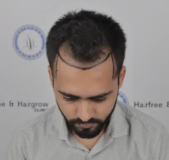 Eleven-month result – thick, natural hairline after hair transplant in Jaipur