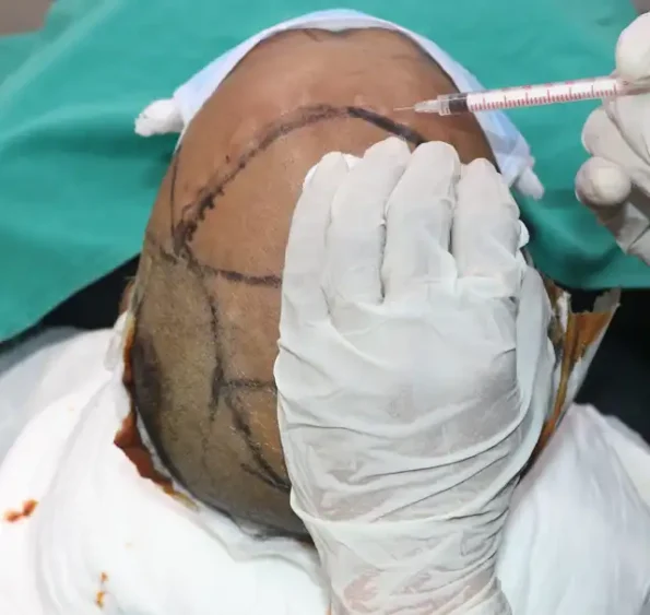Close-up of anesthesia injection near donor region with patient comfort mode