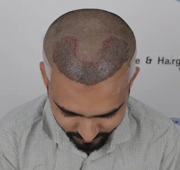 Immediate post-op top view – intact grafts and mild redness after transplant