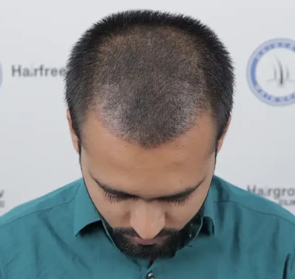 Month 1 frontal view showing temporary reduction in visible density