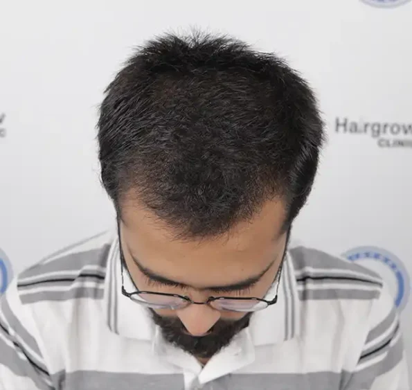 Month 3 top view – sprouting hairs filling previous bald areas