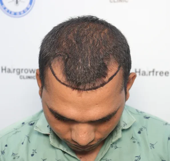 Patient frontal view before transplant showing advanced recession and crown thinning
