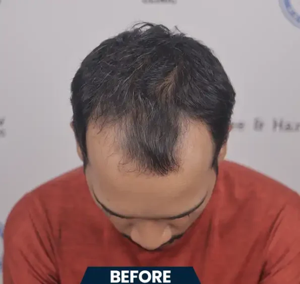 Right-profile view – receding hairline through to dense regrowth seven months post-transplant