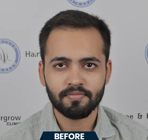 Right-profile sequence showing receding hairline to dense regrowth seven months after transplant