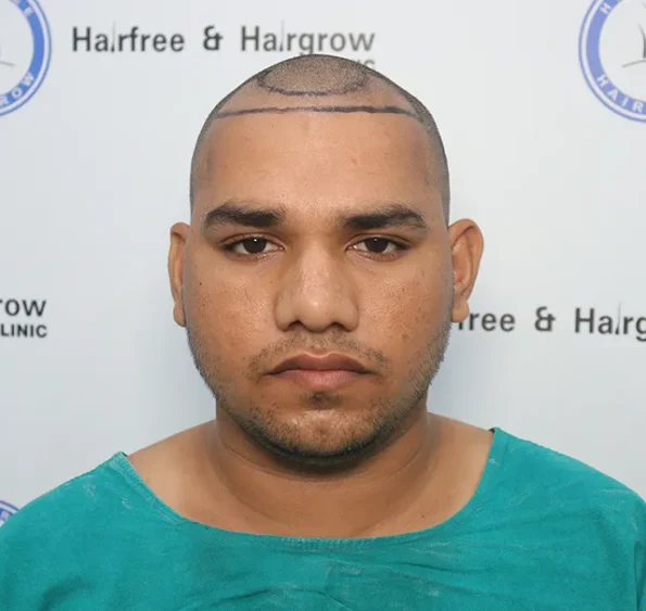 Pre-op top view showing diffuse crown thinning before transplant in Ludhiana