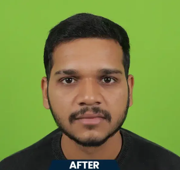 Right-profile view – receding hairline through to dense regrowth seven months post-transplant