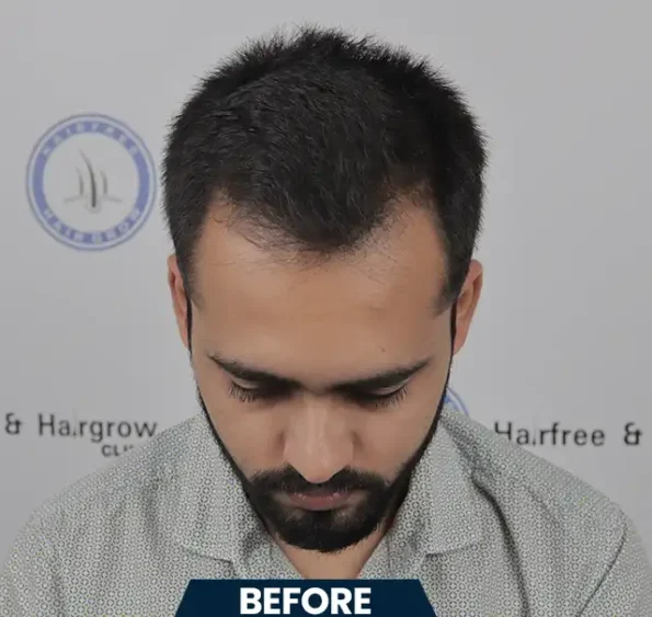 Left-profile sequence highlighting natural density restored after hair transplant