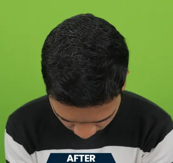 Left-profile sequence highlighting restored density after hair transplant in Chandigarh
