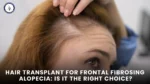 Hair Transplant for Frontal Fibrosing Alopecia: Is It the Right Choice.