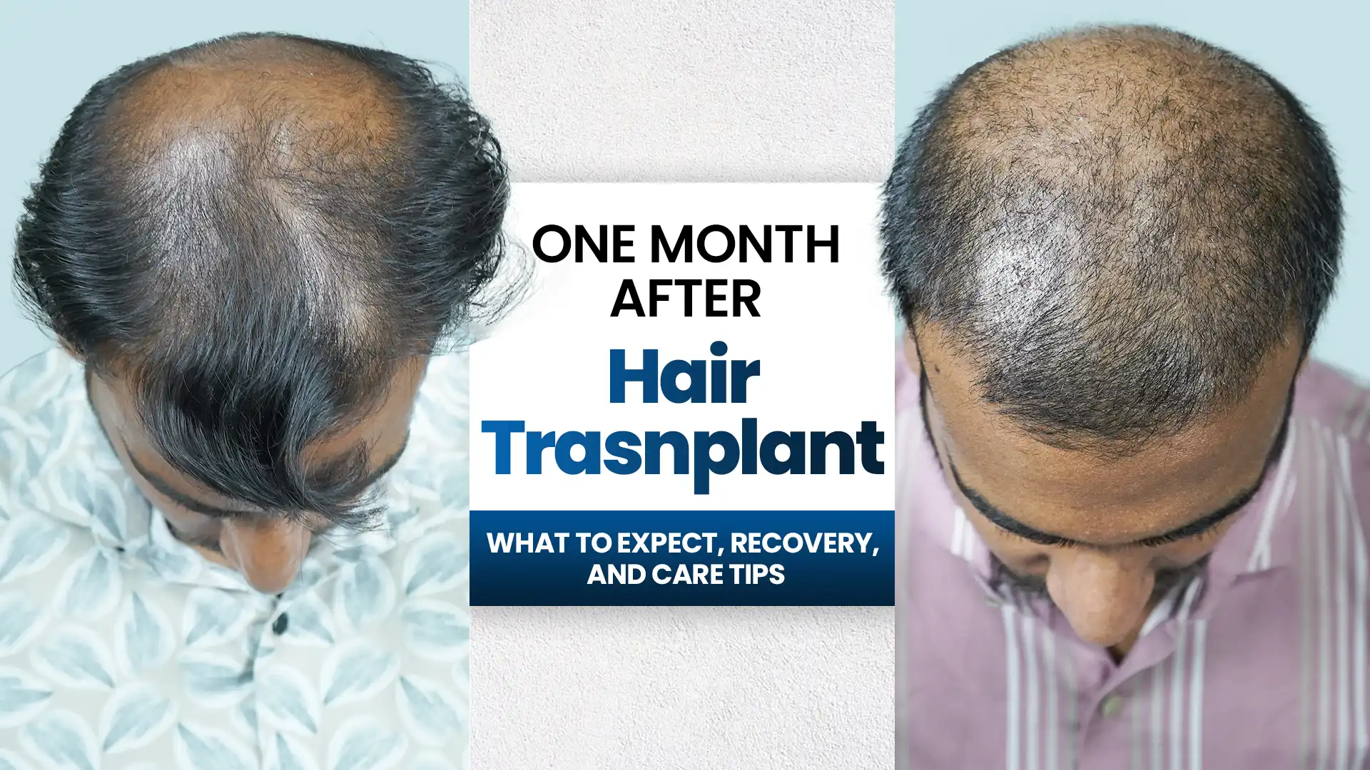This infographic shows how One Month After Hair Transplant shows