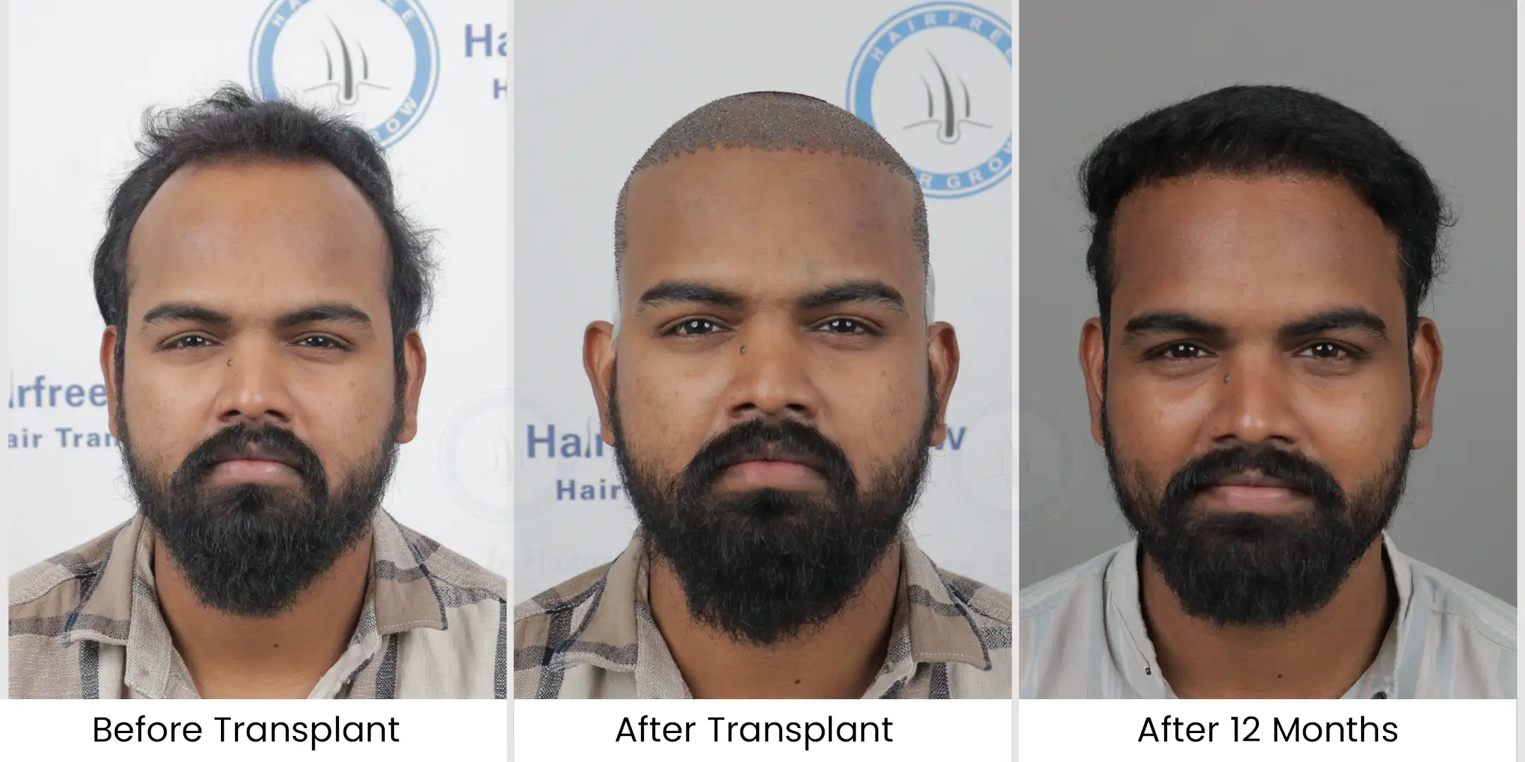 Hair Transplant in Chennai - Hair Free Hair Grow 23 1