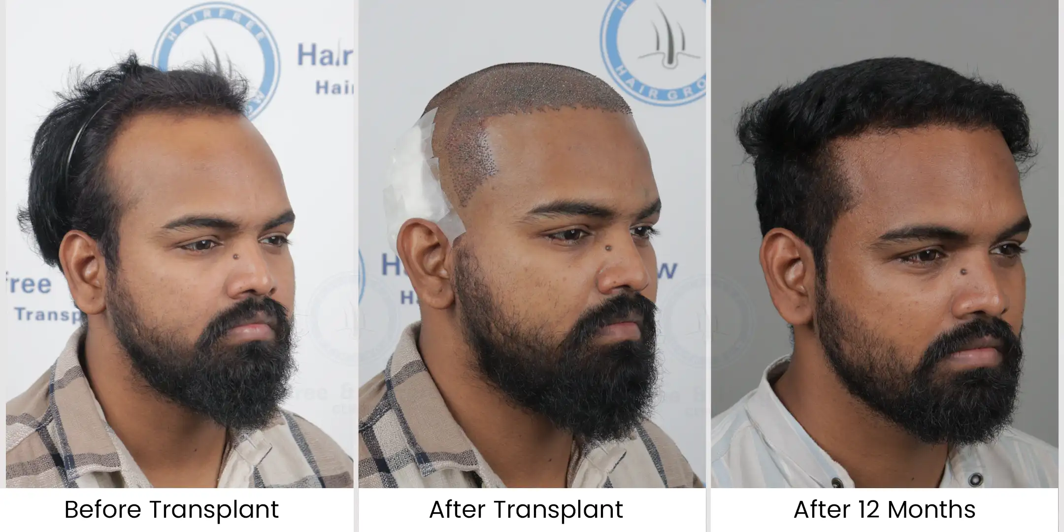 Hair Transplant in Chennai - Hair Free Hair Grow 25 3