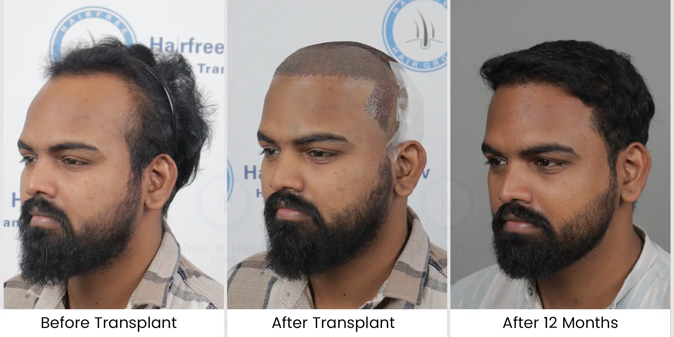 Hair Transplant in Chennai - Hair Free Hair Grow 26 4