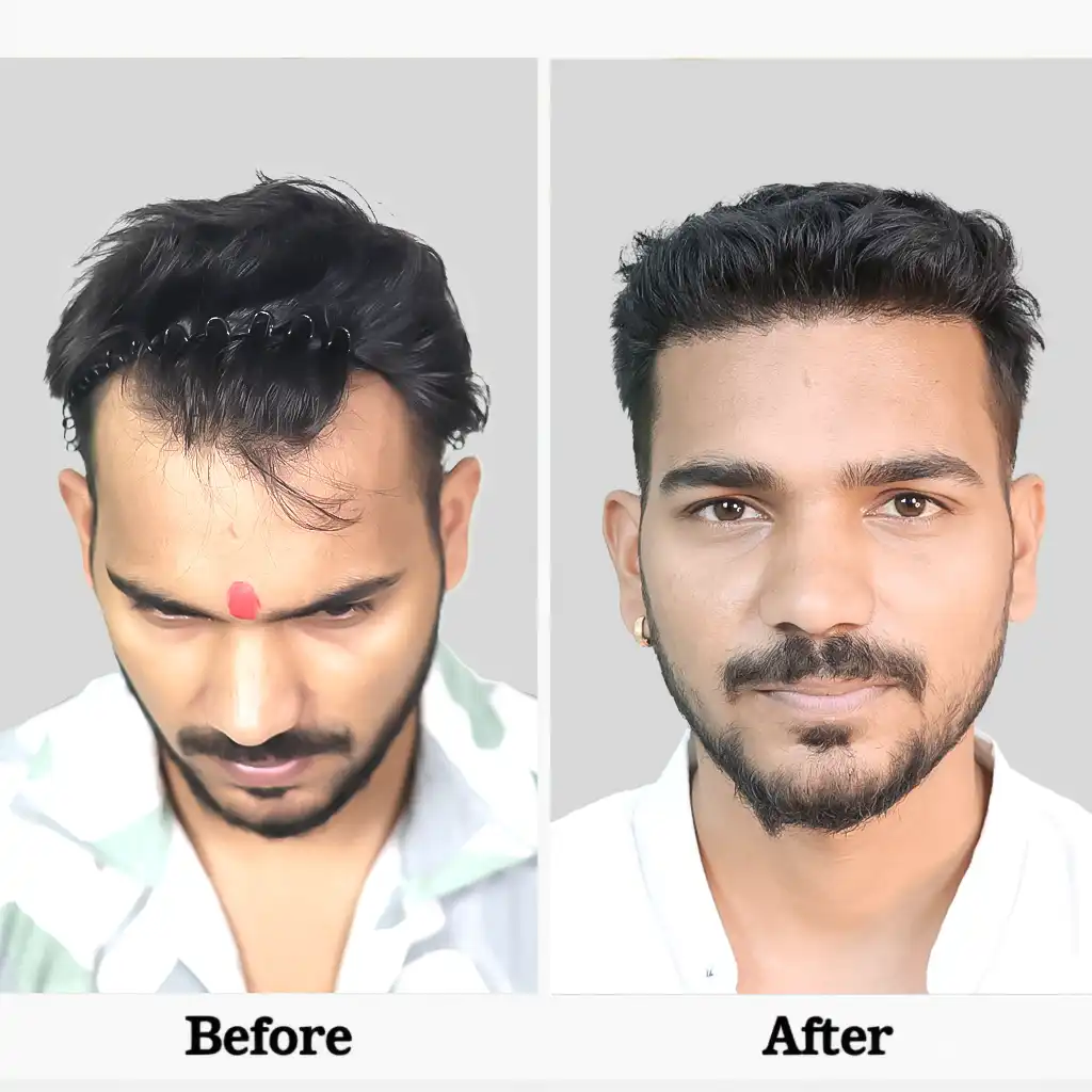 Before After .1I FUE 1 2