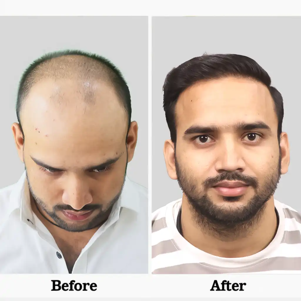 This info graphic shows how Big-FUE surgery success in Big our Harifree & Hairgrow clinic