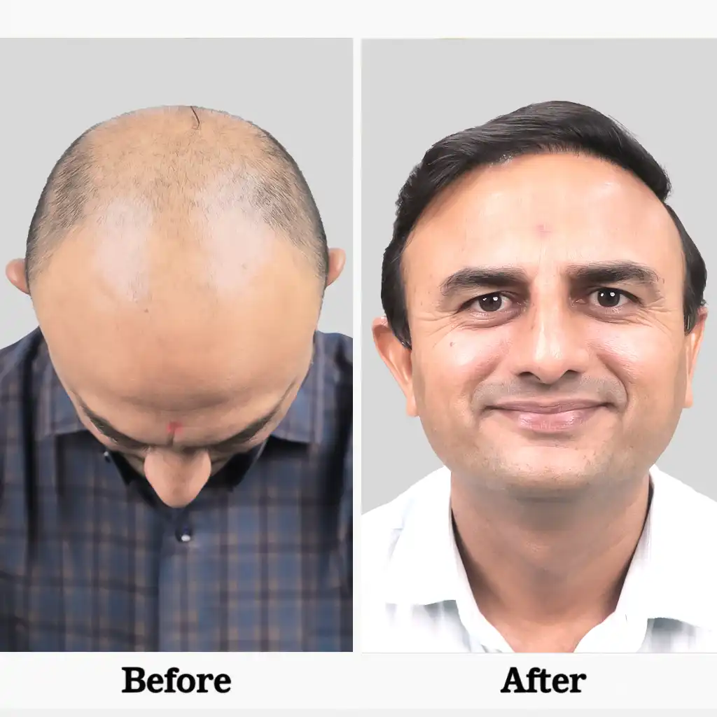this infographic show how HFHG's hair transplant surgery's after and before results.
