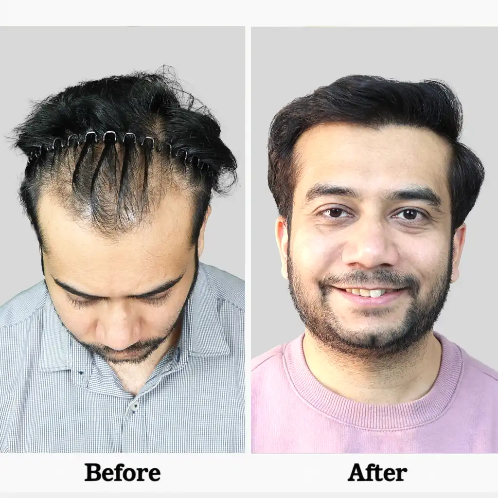 Before After .2BIG FUE 1 2