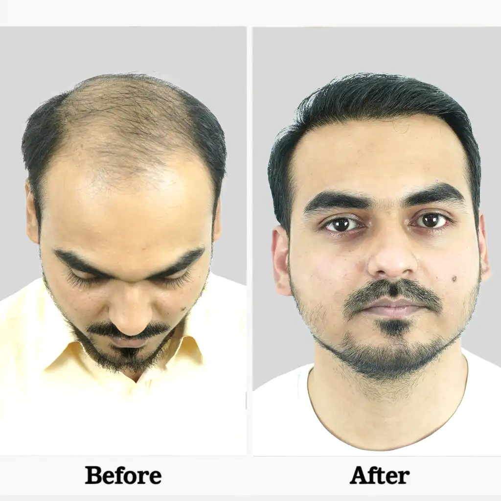 this infographic show how HFHG's hair transplant surgery's after and before results.
