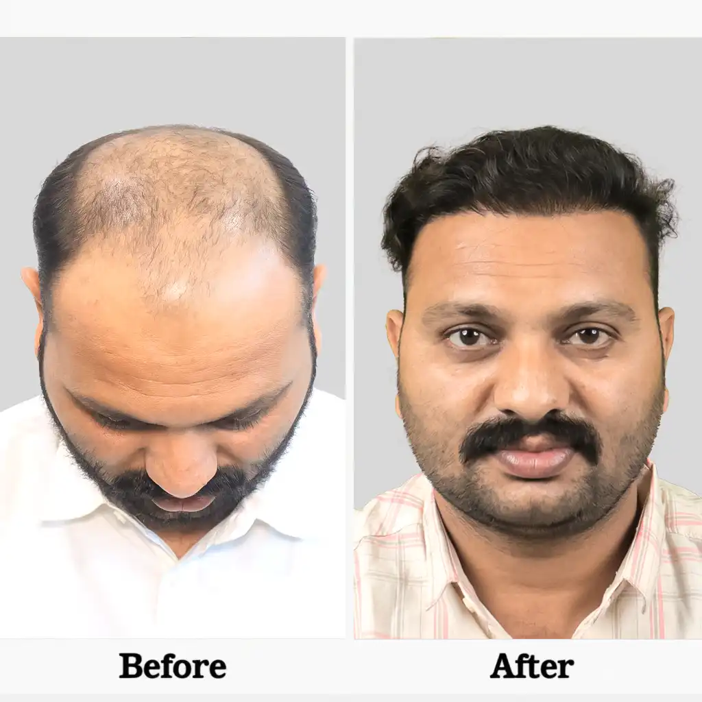 Hair regrowth shown before and after – Hair Transplant Cost in Jamshedpur