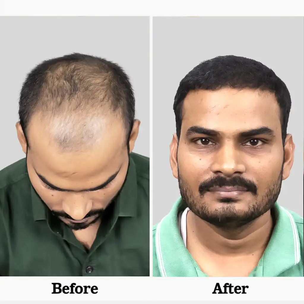 Before After .2I FUE 1 1