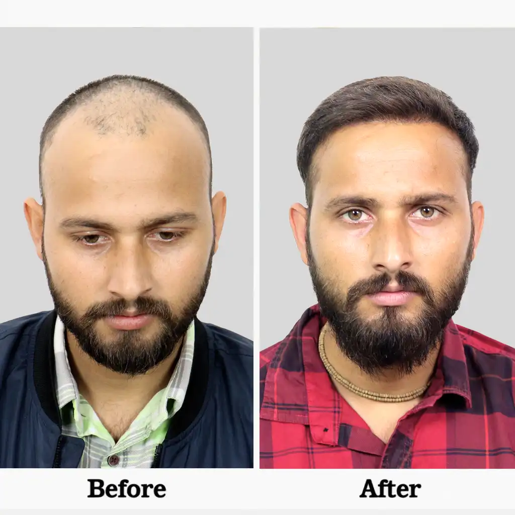 Before After .3BIO FUE