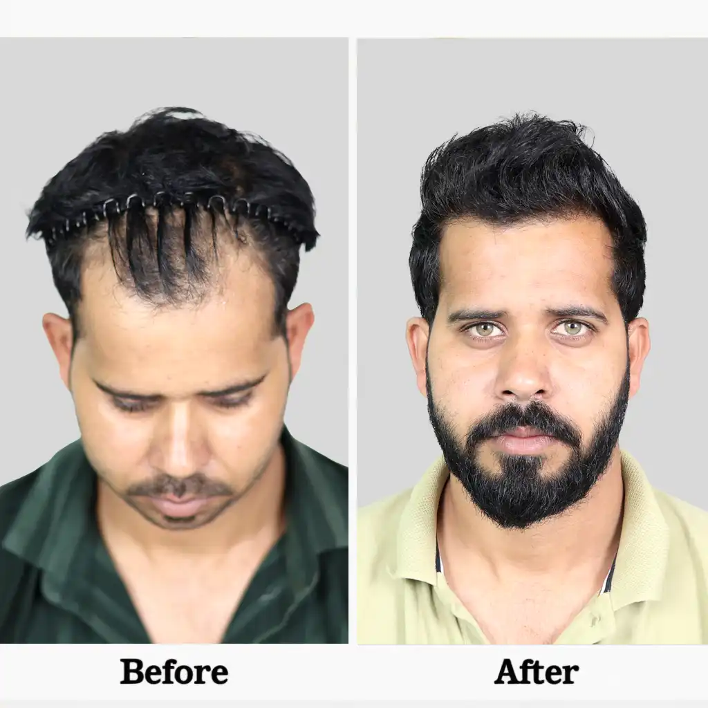 Before After .3BIO FUE 1 1