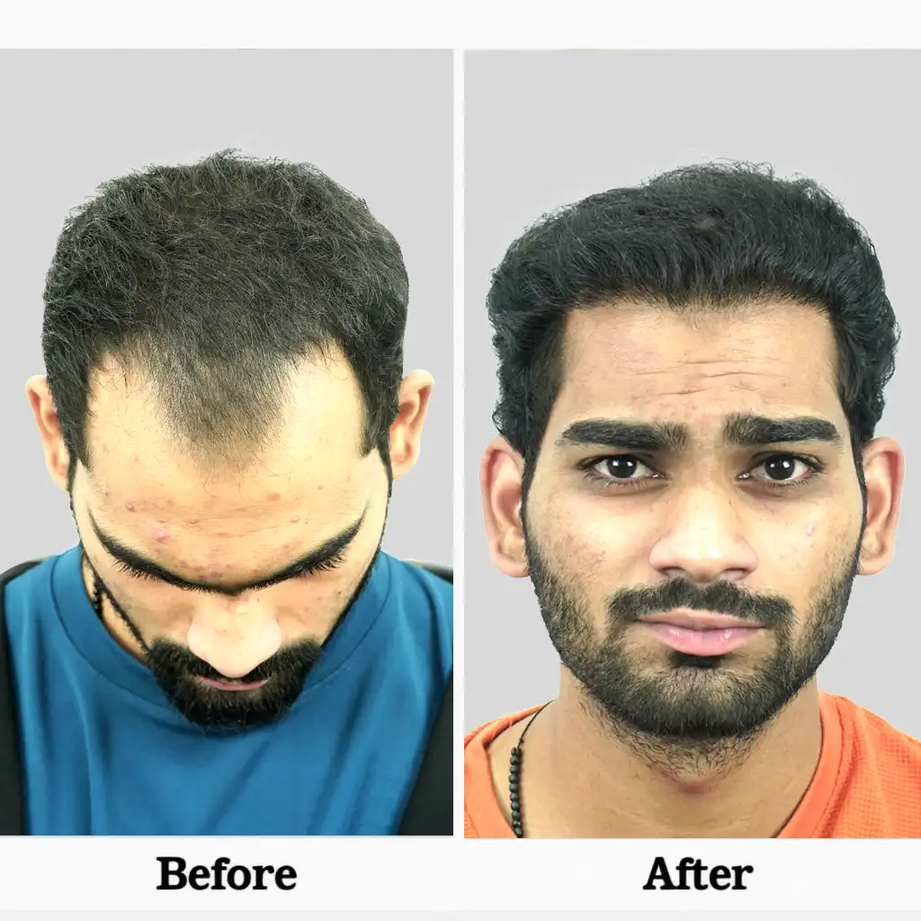 Hair regrowth shown before and after – Hair Transplant Cost in Jamshedpur
