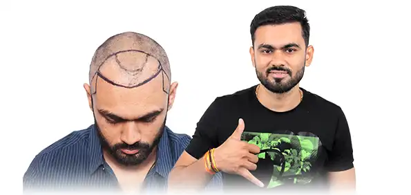 This info graphic shows before-after result at Hairfree & Hairgrow clinic Hyderabad